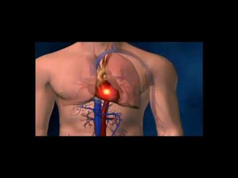Blood Clot in the Lungs from a Leg Vein