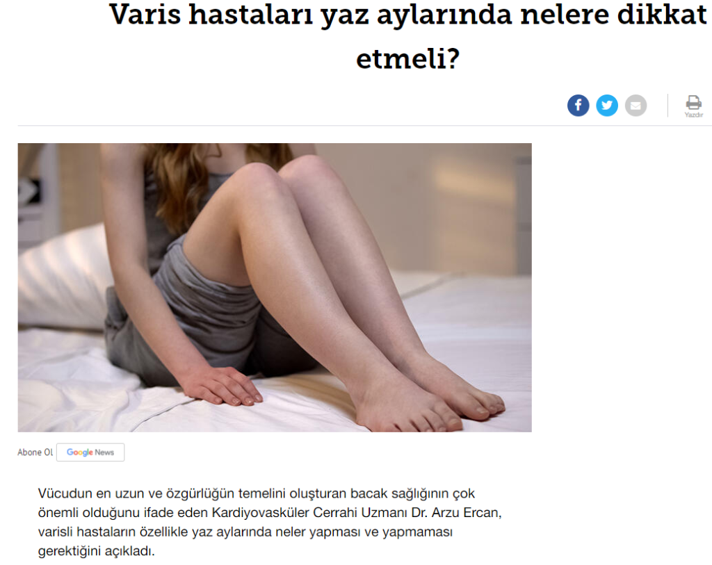 What should varicose vein patients watch out for in summer?